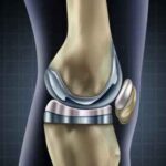 Knee replacement