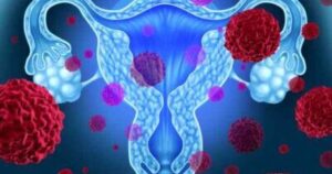 Ovarian Cancer Treatment (1)