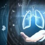 Cost of Pneumonectomy