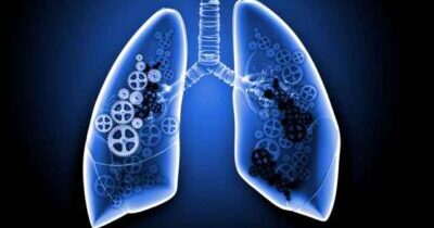 Cost of Pneumonectomy
